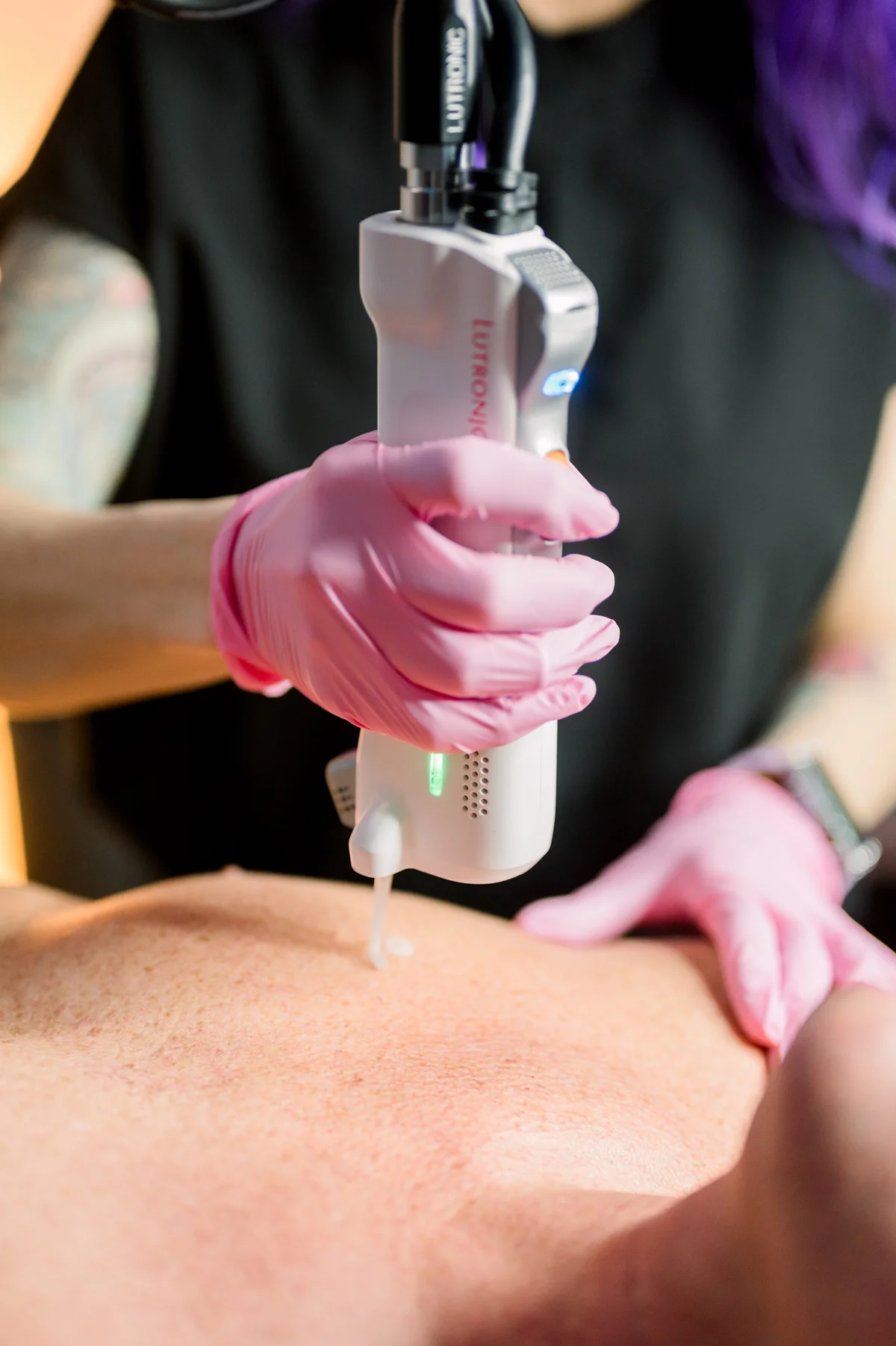 Photofacial Laser in Alabama